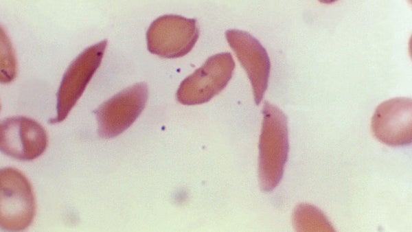 La FDA aprueba el primer tratamiento de tecnología de edición genética en EE.UU.